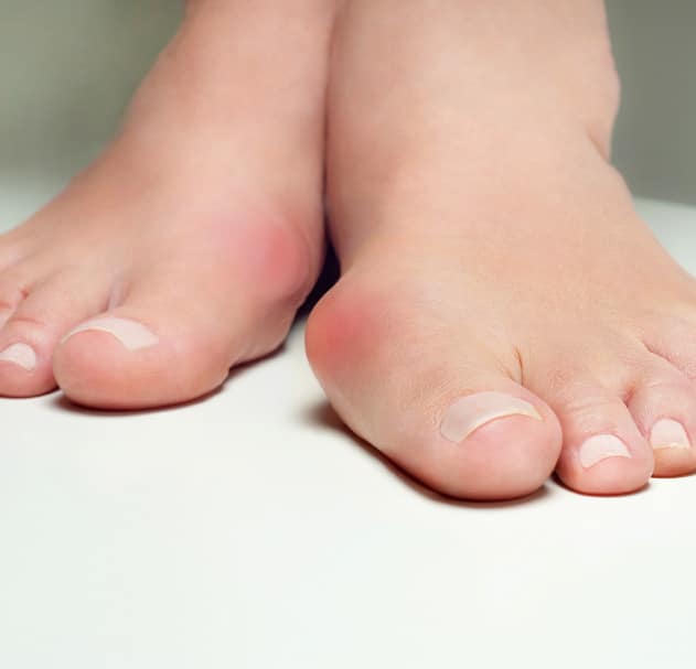 Füße mit Hallux valgus